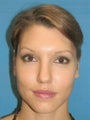 Otoplasty Ear Surgery - Woman