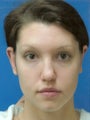 Otoplasty Ear Surgery - Woman