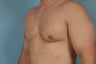 Gynecomastia 