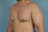 Gynecomastia 