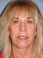 63 year old female desires facial rejuventation