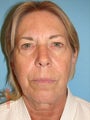 63 year old female desires facial rejuventation