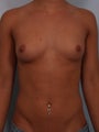 Breast Augmentation