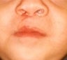 Infant who underwent surgery for a cleft lip and palate 