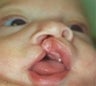 Infant who underwent surgery for a cleft lip and palate 