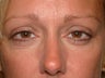 Endoscopic brow lift