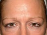 Endoscopic brow lift