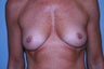 Breast Augmentation
