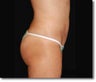 Laser Liposuction