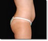Laser Liposuction