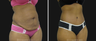 Tummy Tuck