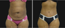 Tummy Tuck