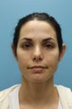 Female Treated for Revision Rhinoplasty