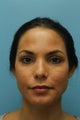 Female Treated for Revision Rhinoplasty