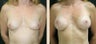 Breast Augmentation
