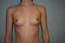 Breast Augmentation