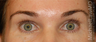 Eyelid Surgery