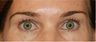 Eyelid Surgery
