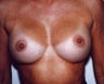 36 Year Old Female Breast Augmentation