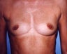 36 Year Old Female Breast Augmentation