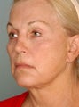 Neck lift