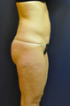 41 Year old Female Liposuction abdomen, inner thighs and knees
