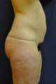 41 Year old Female Liposuction abdomen, inner thighs and knees