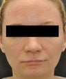 Facial Aging Grooves