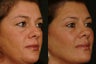 Eyelid Surgery