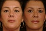 Eyelid Surgery