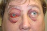 Facial Reconstructive Surgery