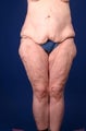 42 Year Old Femal With Medial Thigh Laxity After Weight Loss