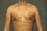 Male Breast Reduction