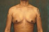 Male Breast Reduction