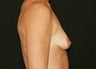 Breast Lift