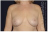 Mastopexy