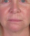 Bullhorn Subnasale Lip Lift