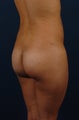 Butt Implants