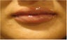 Lip Augmentation