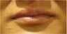 Lip Augmentation