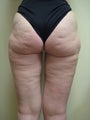 Smart Lipo