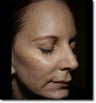 Liquid Facelift