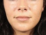 Natural looking lip injections