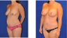 Mommy Makeover- breast Augmentation, breast lift, Tummy Tuck, and liposuction