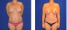 Mommy Makeover- breast Augmentation, breast lift, Tummy Tuck, and liposuction
