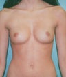 19-Year-Old Breast Augmentation 