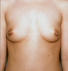Breast Implants