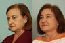 Hair Transplantation
