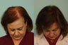 Hair Transplantation