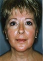 Liposuction - Lower Face - Lower Eyelid - Upper Neck